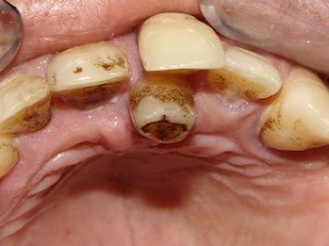 Featured image of post Dente Encavalado Nascendo Saiba mais sobre a denti o nos recursos do centro de