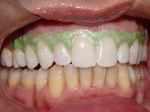 Clareamento-Dental-1
