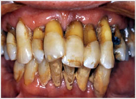gengivite-periodontite-4