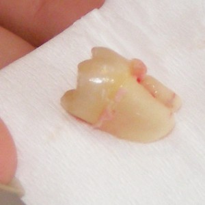 Extrated Wisdom Tooth
