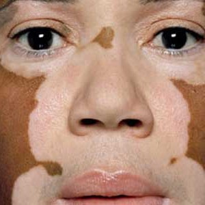 vitiligo_slider
