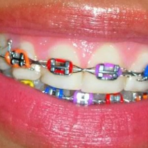 aparelho dentário colorido