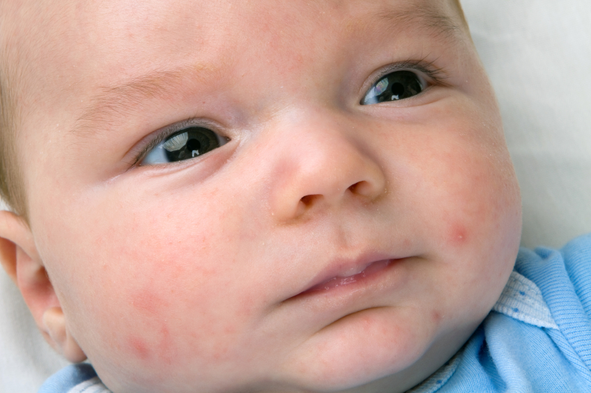 acne neonatal istock getty images doutíssima