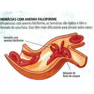 anemia falciforme