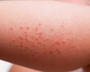 sintomas de alergia ao sol