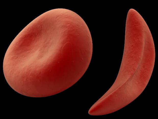 Anemia Falciforme Uma Doença Pouco Conhecida Mas Que Merece Sua Atenção Clínica Geral 