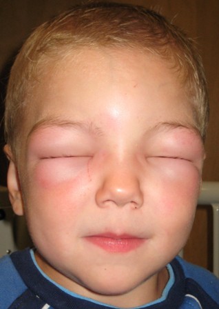 sinais de alergia