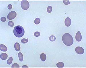 anemia megaloblástica
