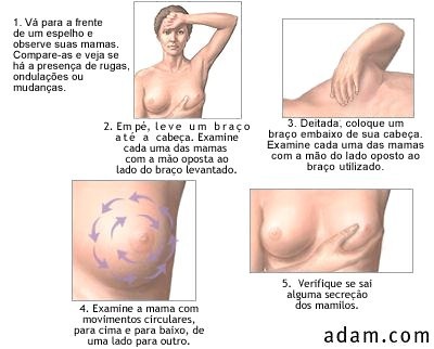tratamento do câncer de mama