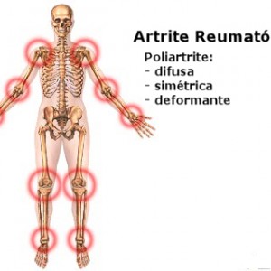 artrite é irreversível