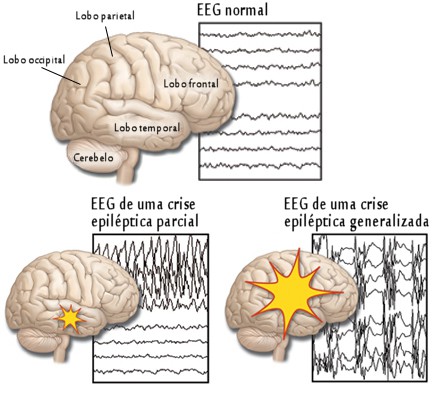 ataques epiléticos
