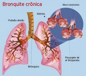 bronquite crônica