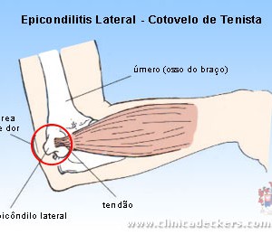 epicondilite lateral