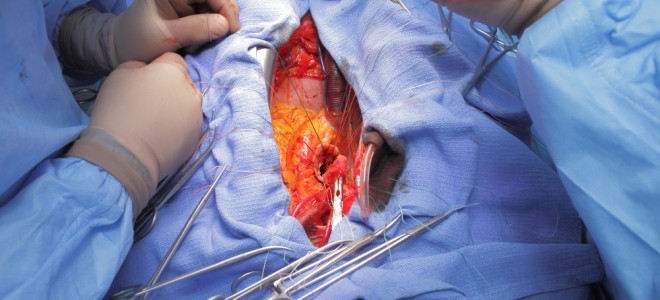Cirurgia de troca de válvula é realizada com auxílio de circulação extracorpórea. Foto: Shutterstock