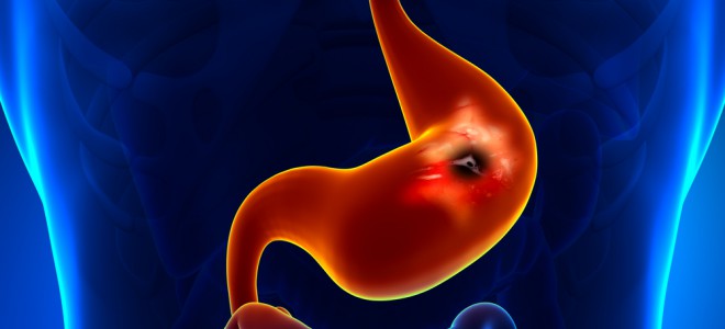 Prevenção das úlceras no estômago e duodeno pode ser feita com dieta cuidadosa. Foto: Shutterstock