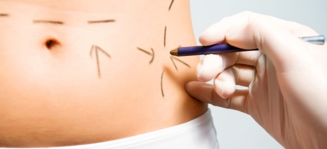 Mini-abdominoplastia elimina gordura e flacidez entre o umbigo e região púbica. Foto: Shutterstock