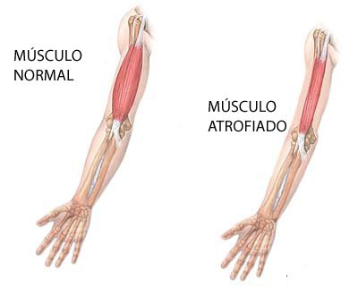 distrofias musculares