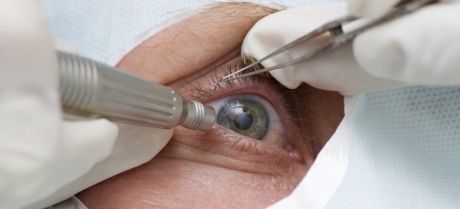 cirurgia ocular