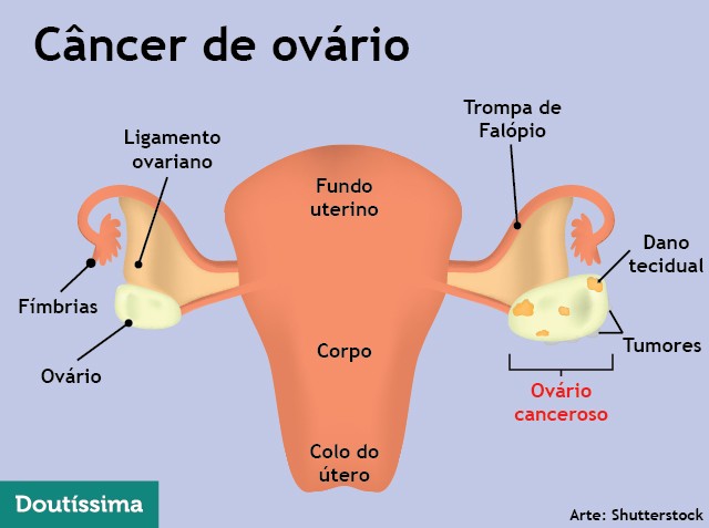 Ooforectomia - Dicio, Dicionário Online de Português