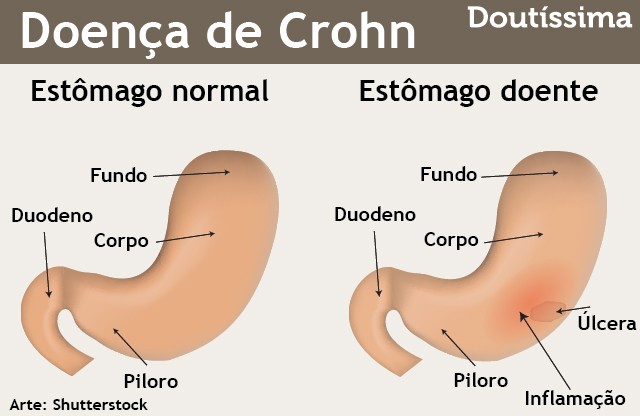 doença de crohn