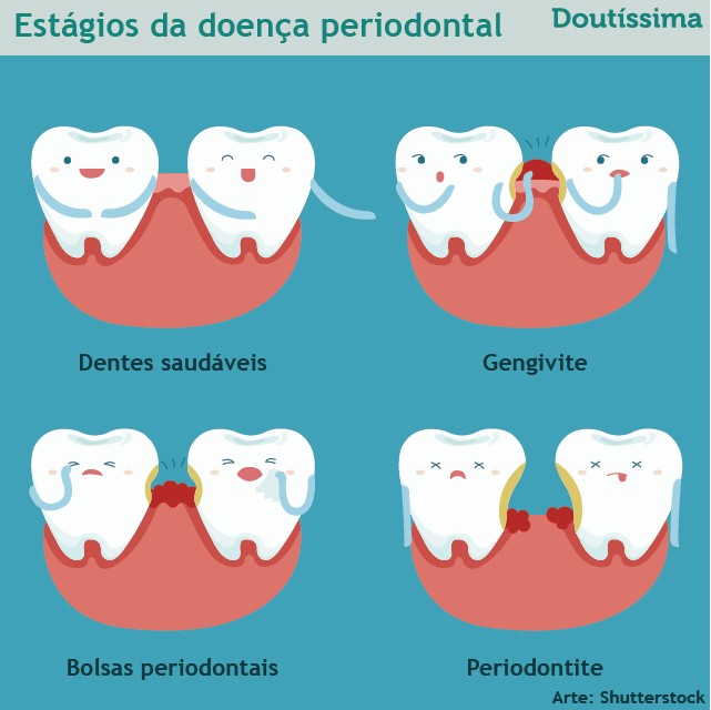 periodontite