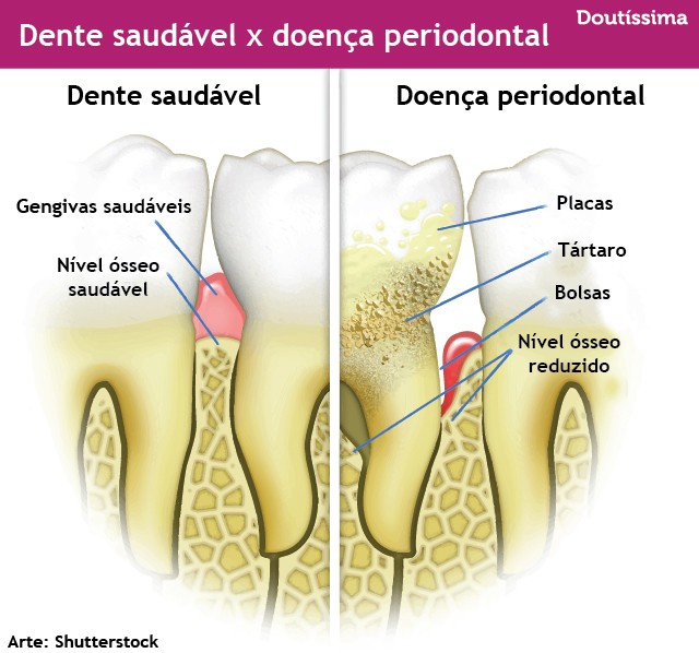 doença periodontal
