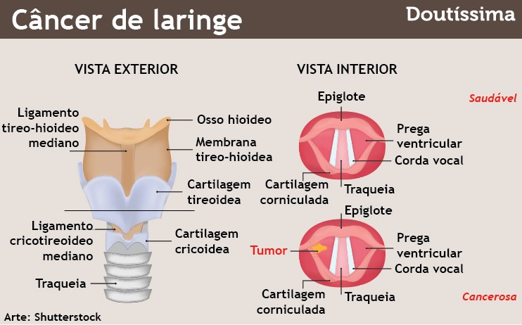Câncer de laringe
