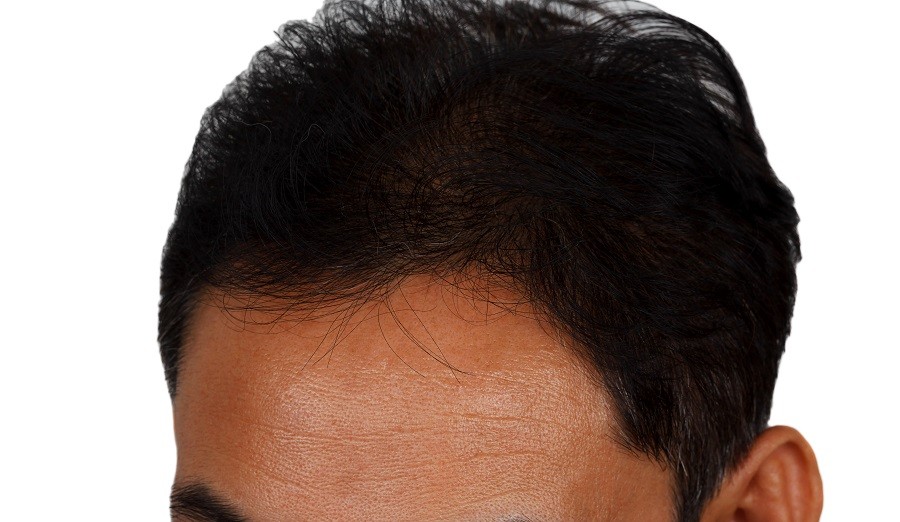 inflamação no couro cabeludo