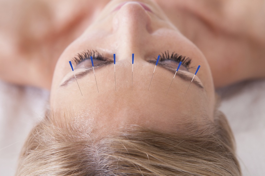Dores de cabeça podem ser tratadas com acunputura. Foto: iStock/GettyImages