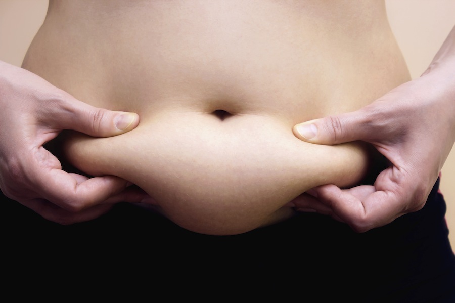 Flacidez na barriga pode ser tratada com abdominoplastia. Foto: iStock/GettyImages